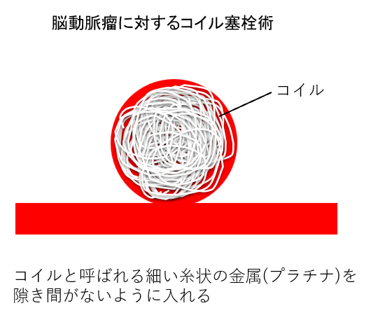 脳動脈瘤に対するコイル塞栓術