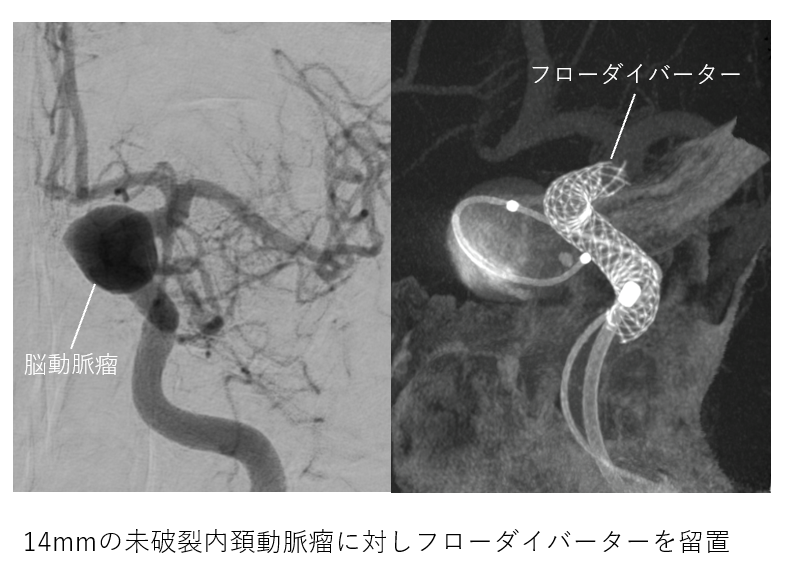 フローダイバーター治療｜最新医療｜先進医療・最新医療｜独立