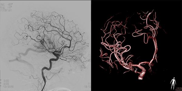 脳血管と術中3D画像
