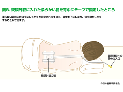 オンデマンド無痛分娩の様子 図解